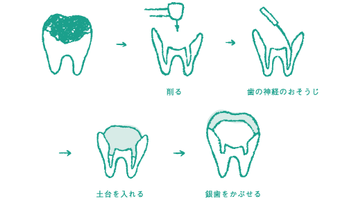 大きなむし歯